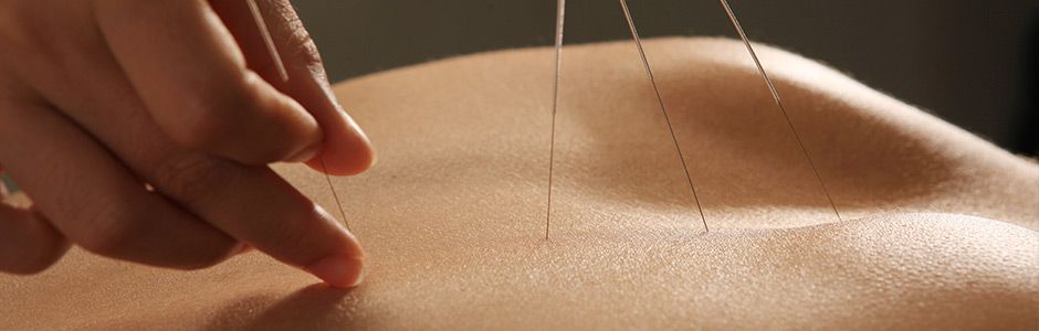 akupunktur københavn